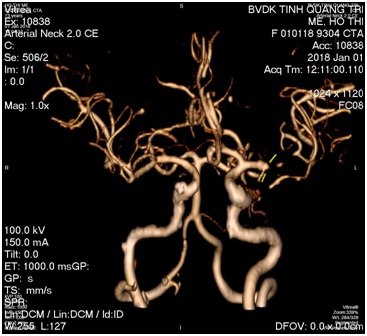 BVĐK tỉnh Quảng Trị đã triển khai thành công kỹ thuật lấy huyết khối động mạch não trựa tiếp ở bệnh nhân nhồi máu não đến sớm dưới máy X-quang số hóa xóa nền (DSA)