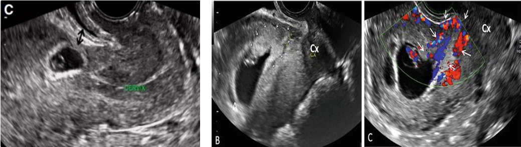 Hình ảnh siêu âm đầu dó âm đạo thai ngoài tử cung ở vết mổ cũ