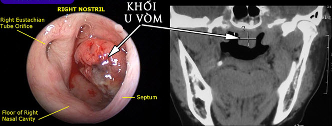 Hình 3. Hình ảnh nội soi và cắt lớp vi tính khối u vòm họng