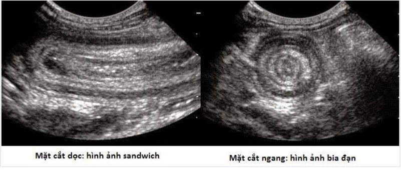 Hình 2: Hình ảnh siêu âm của lồng ruột