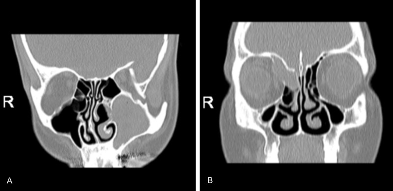 Hỉnh ảnh u nhầy xoang hàm và xoang sàng trên CT scan (Nguồn: Murat Topdag ,  Mete Iseri ,  Fatih Sari ,  Selvet Erdogan , và I Gurkan Keskin .Paranasal sinus mucoceles: our clinical experiments 2015)
