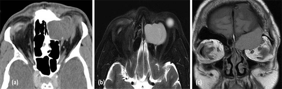 (a) Hình ảnh CT scan lát cắt axial cho thấy u nhầy xoang trán- sàng trái gây tiêu xương thành trong ổ mắt trái và (b) Hình ảnh MRI lát cắt axial và (c) nhát cắt coronal trên cùng 1 bệnh nhân cho thấy hình ảnh xâm lấn vào ổ mắt, gây ra trên lâm sàng bệnh nhân có lồi mắt trái. (Nguồn: Sarah A. AlMansour1, Ali A. AlMomen2 The Endonasal Endoscopic Management of Paranasal Sinuses Mucoceles (2021))