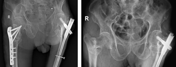 Nẹp khoá đầu trên xương đùi