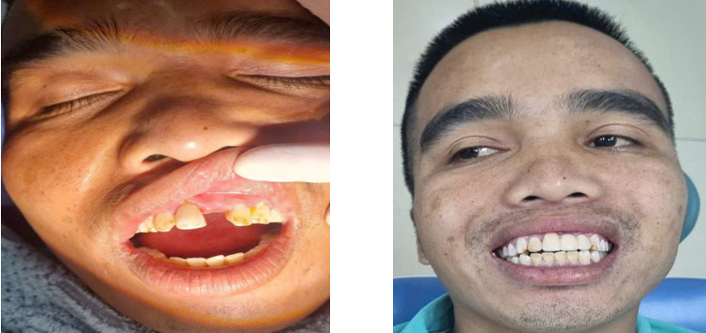 Hình ảnh bệnh nhân trước và sau khi làm phục hình sứ cho răng