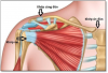 Tổng quan trật khớp cùng đòn và các phương pháp điều trị