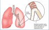 Viêm tiểu phế quản cấp ở trẻ em