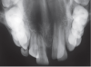 Răng thừa: nguyên nhân phổ biến gây chậm mọc răng ở trẻ em