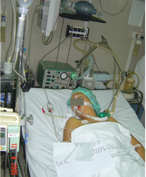 Hình 2: Bệnh nhân tự dùng paracetamol quá liều để hạ sốt dẫn tới ngộ độc, viêm gan, hôn mê gan (sau đó tử vong) (Trung tâm chống độc BVBM)