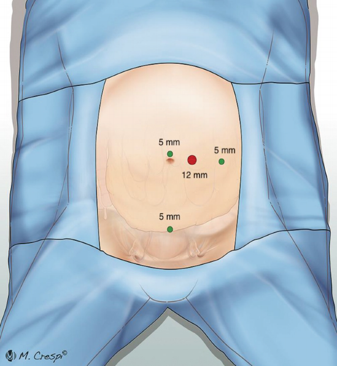 Vị trí đặt trocar trong phẫu thuật nội soi ổ bụng thắt tĩnh mạch tinh          