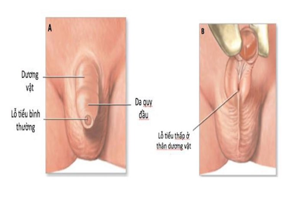 Lỗ tiểu lệch thấp (hypospadias)