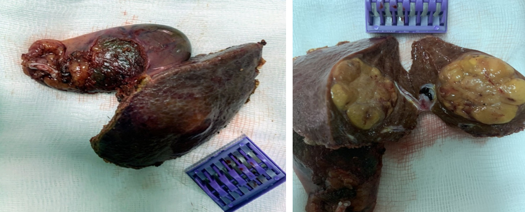 Hình ảnh khối u gan sau khi phẫu thuật- Khối u gan HPT V kèm túi mật