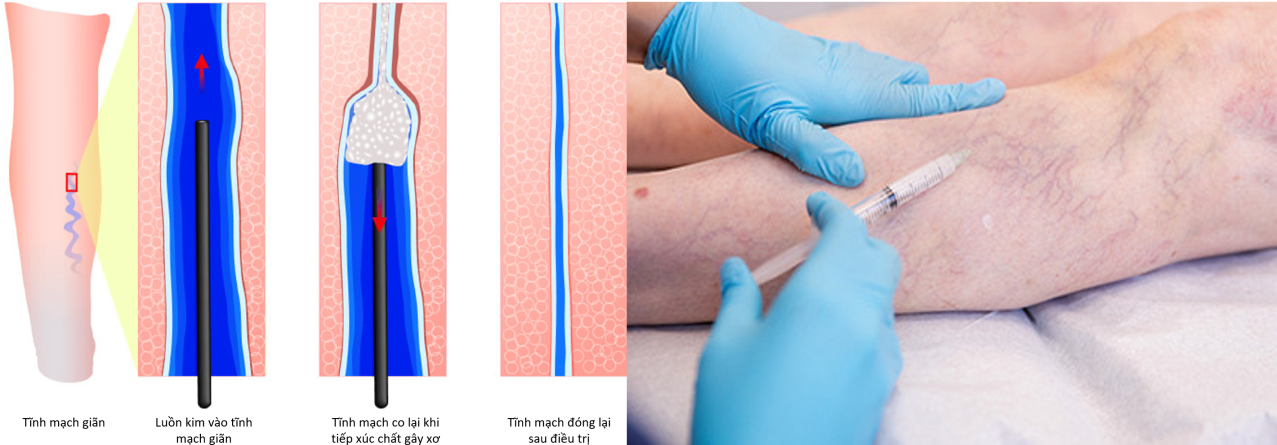 Phương pháp tiêm xơ điều trị suy tĩnh mạch chi dưới