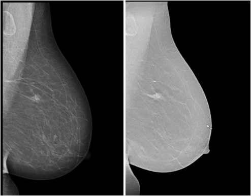 Hình ảnh chụp Mammography tuyến vú