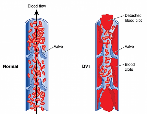  Thuyết tắc phổi