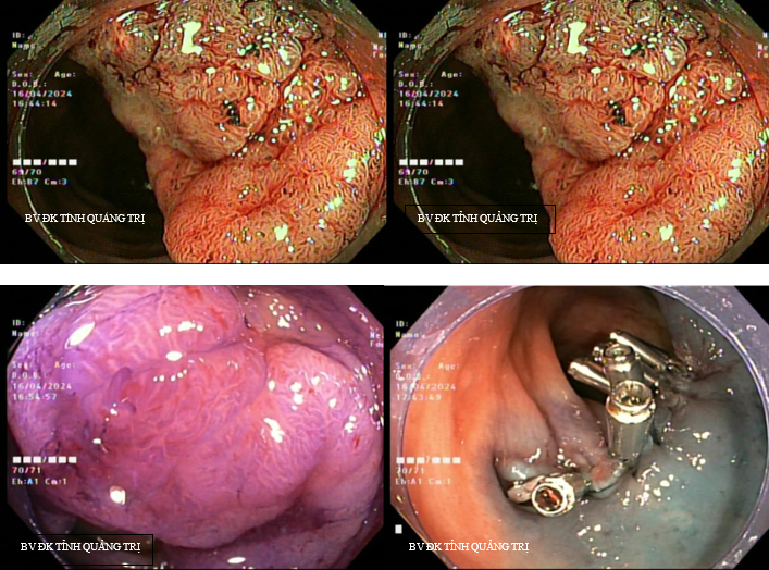 Hình ảnh polyp đại tràng trước và sau khi đã được cắt bỏ dưới nội soi