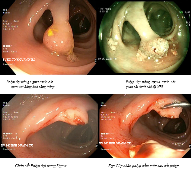 Hình ảnh polyp đại tràng trước và sau khi đã được cắt bỏ dưới nội soi