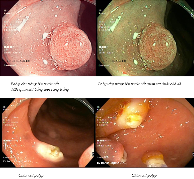 Hình ảnh polyp đại tràng trước và sau khi đã được cắt bỏ dưới nội soi